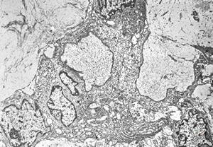 F,22y. | Pindborg tumor F,22y. | Pindborg tumor